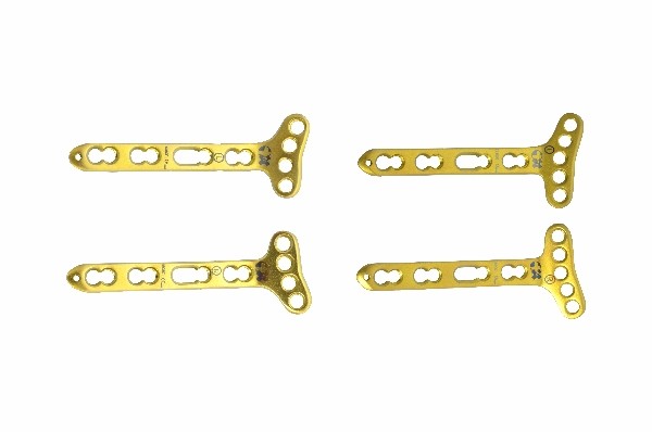 Volar Distal Radius Locking Plates Extra-Articular
