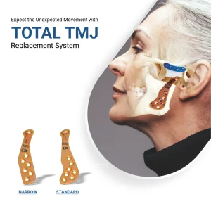 TOTAL TMJ Replacement System