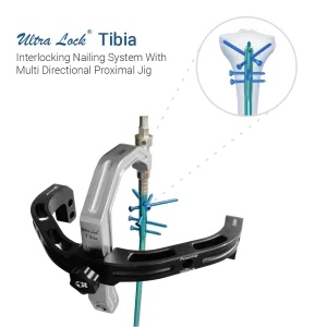 Ultra Lock® Tibia Interlocking Nailing System With Multi Directional Proximal Jig