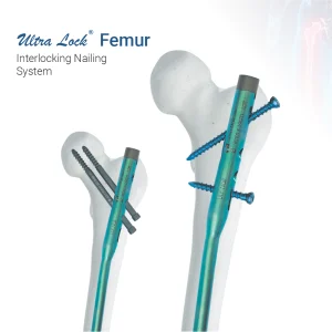Ultra Lock® Femur Interlocking Nailing System