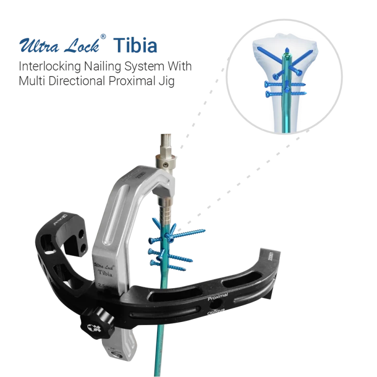 Interlocking Nailing System With multi directional proximal