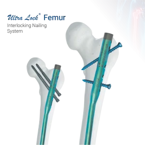 Interlocking Nailing System
