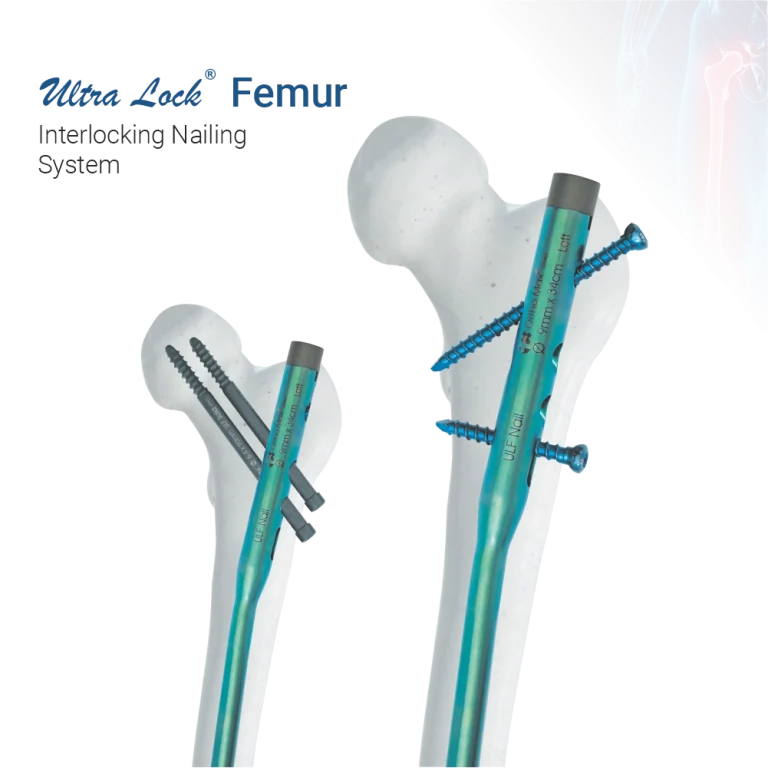 Interlocking Nailing System