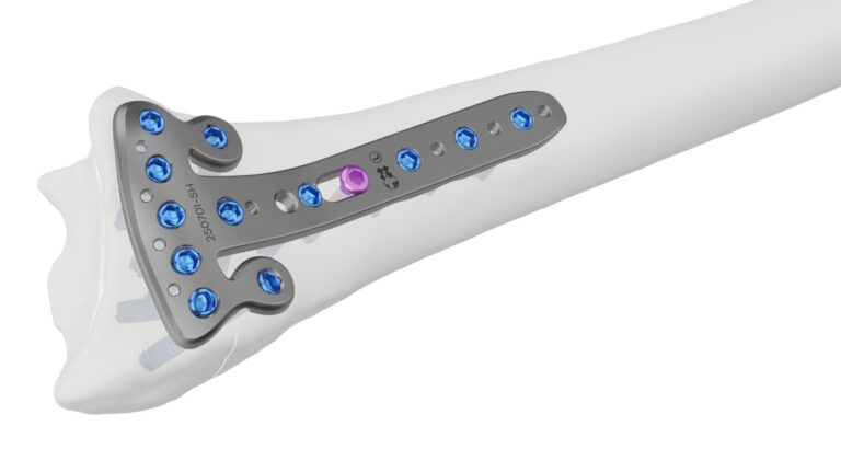 Distal Radius Rim Head Multi-Angle Locking Plateon bone
