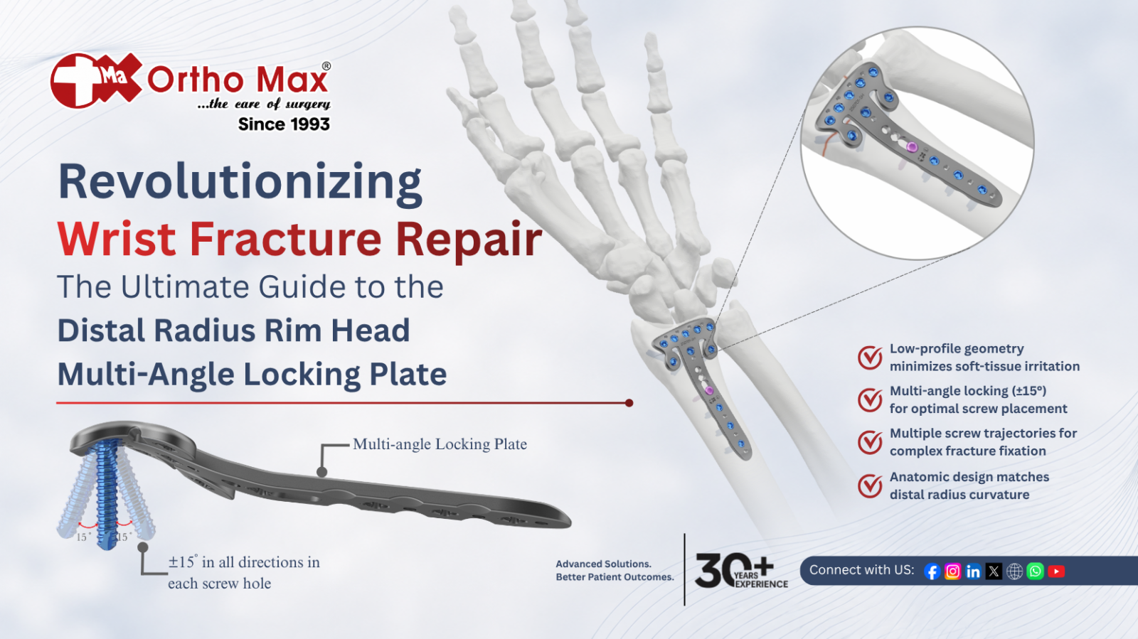 At its most fundamental level, the primary function of the Distal Radius Rim Head Multi-Angle Locking Plate is to provide rigid internal fixation for complex fractures of the distal radius