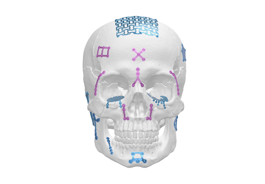 Craniomaxillofacial (CMF) Solutions Implant
