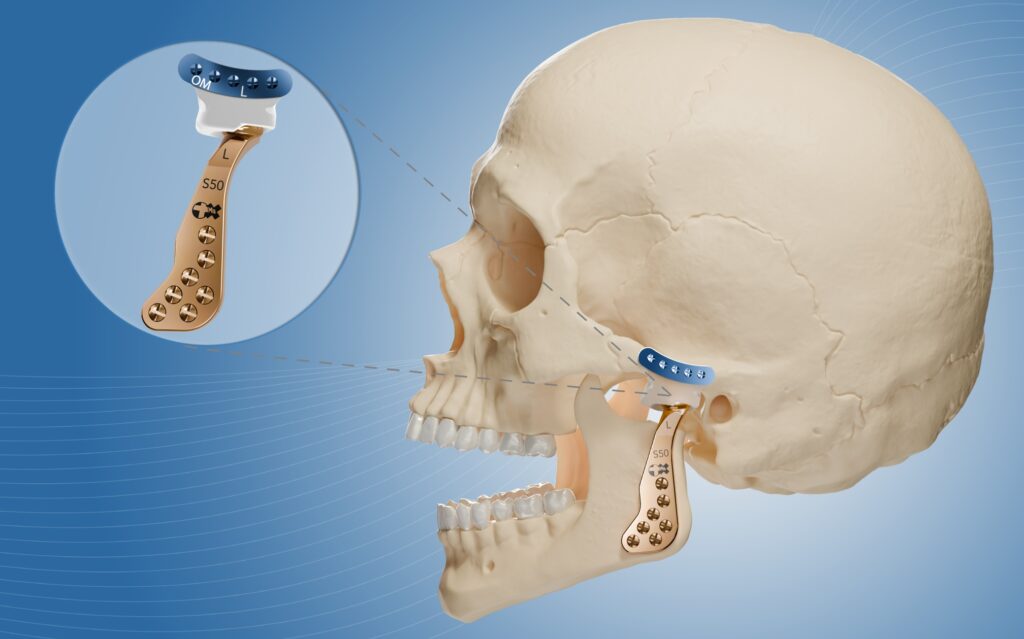 TMJ Prosthesis 1 OrthoMax® Mfg Co Pvt ltd