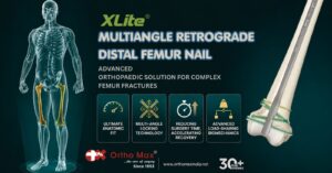 XLite® Multiangle Retrograde Distal Femur Nail – Advanced Orthopaedic Solution for Complex Femur Fractures