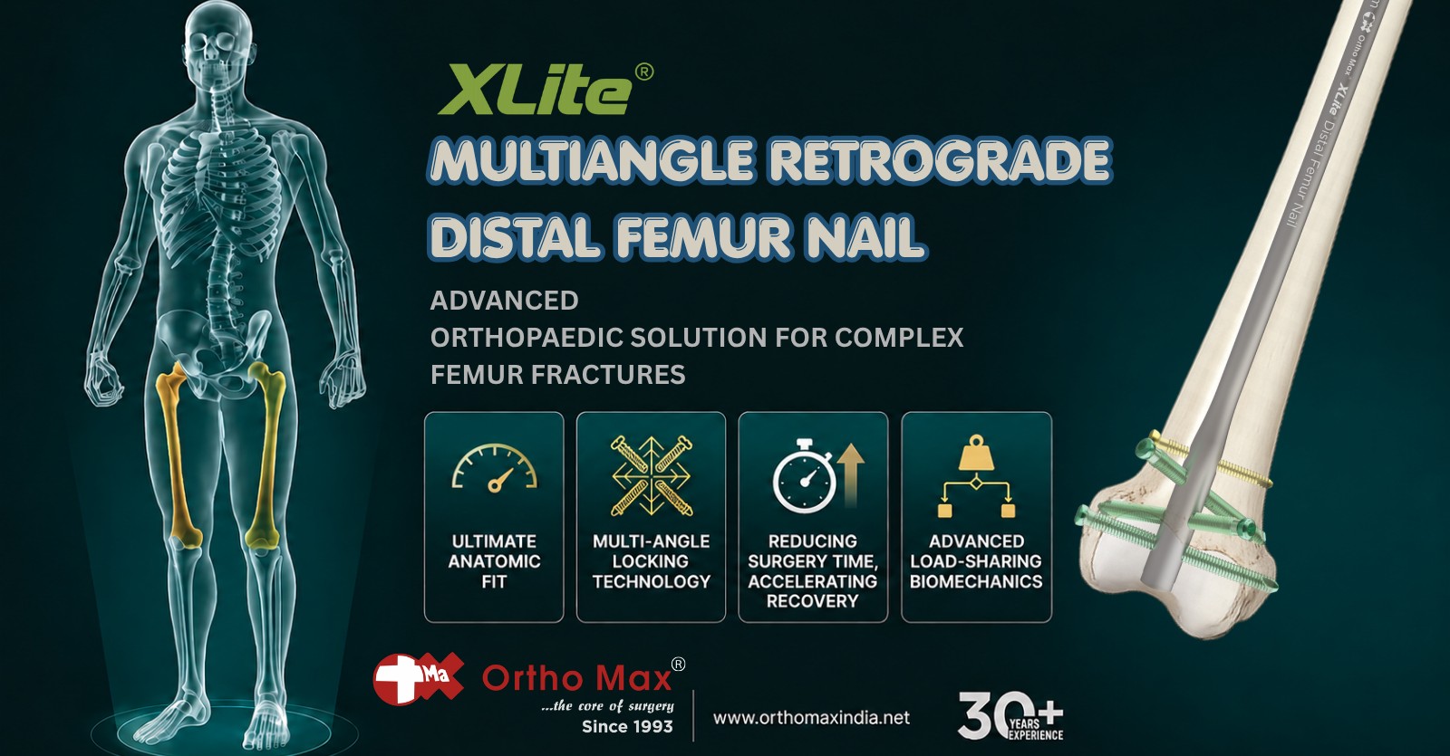 XLite® Multiangle Retrograde Distal Femur Nail – Advanced Orthopaedic Solution for Complex Femur Fractures