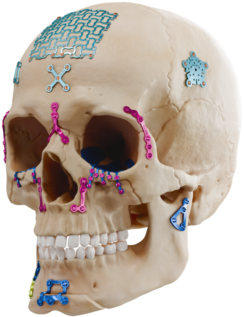 CMF SKULL with ALL PLATE & SCREWS left side
