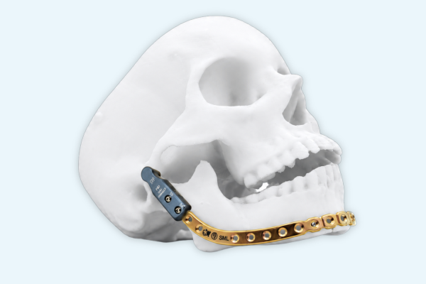 Ultralock® Ezyshape mandibular Reconstruction Plates